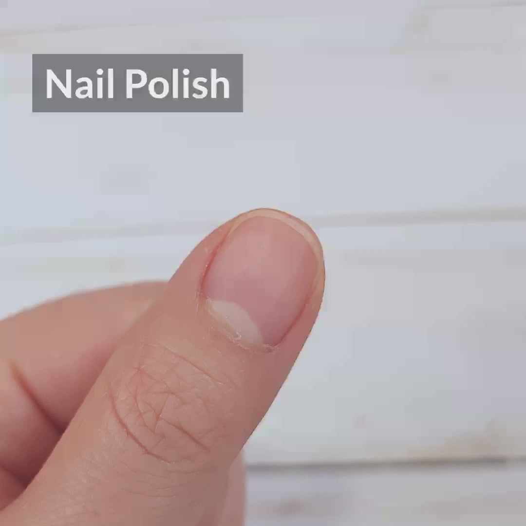 Nail Psoriasis or Fungus? How to know? When to see a doctor?